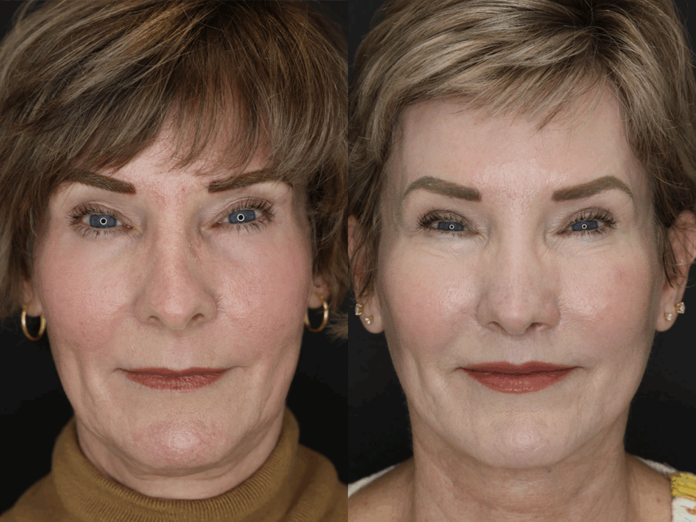 Revision Rhinoplasty case #3596