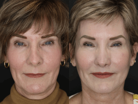 Revision Rhinoplasty case #3596