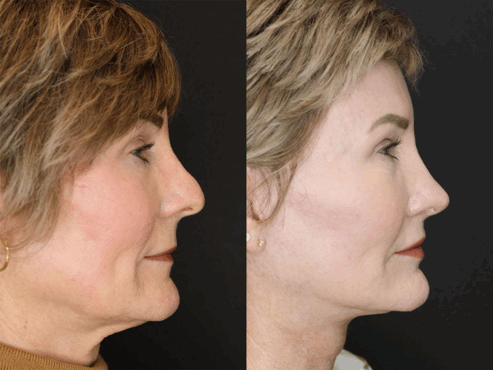 Revision Rhinoplasty case #3596