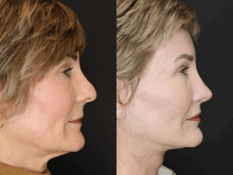 Revision Rhinoplasty case #3596