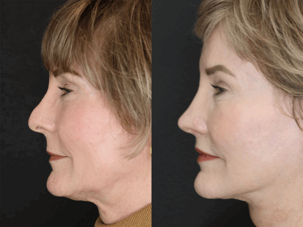 Revision Rhinoplasty case #3596