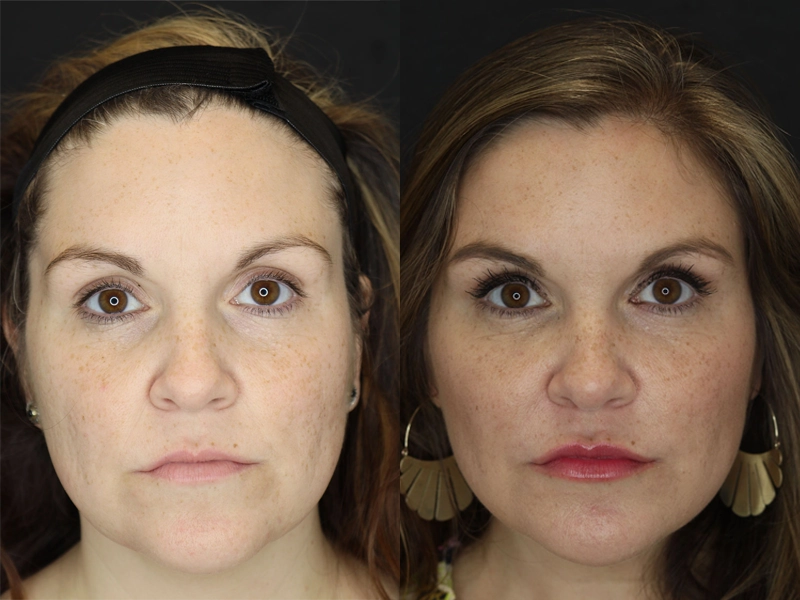 Facial Filler case #3605