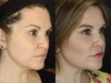 Facial Filler case #3605 slider thumbnail