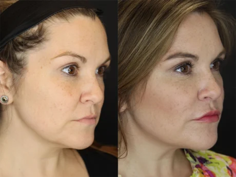Facial Filler case #3605