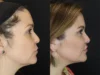 Facial Filler case #3605 slider thumbnail