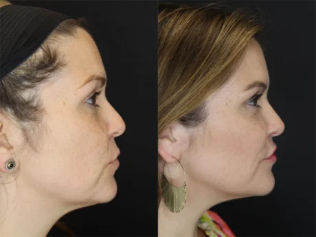 Facial Filler case #3605