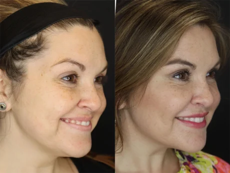 Facial Filler case #3605