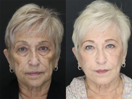 Facial Filler case #3614