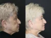 Facial Filler case #3614 slider thumbnail