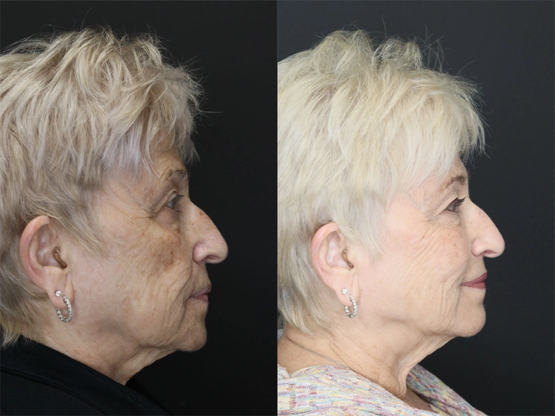 Facial Filler case #3614