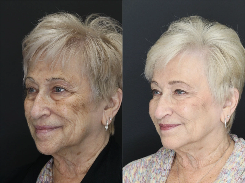 Facial Filler case #3614
