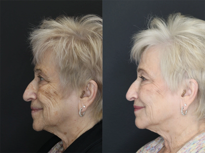 Facial Filler case #3614