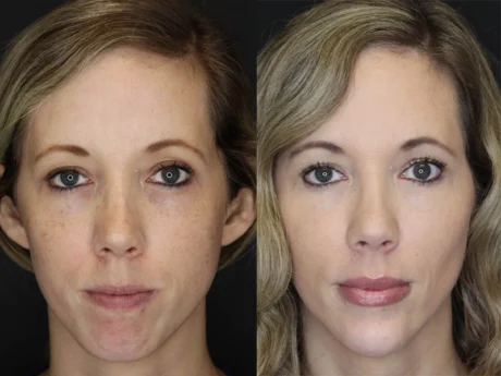 Facial Filler case #3625