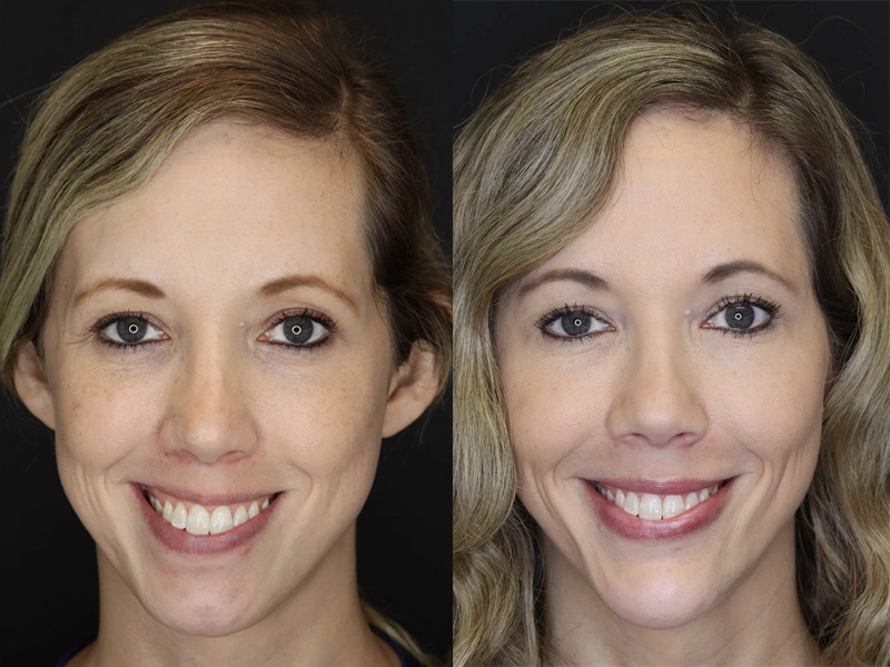 Facial Filler case #3625