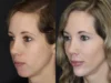 Facial Filler case #3625 slider thumbnail