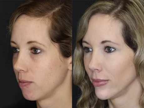 Facial Filler case #3625