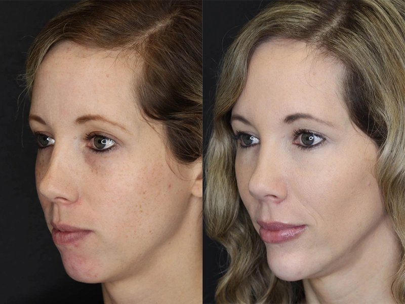 Facial Filler case #3625
