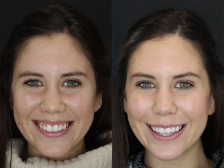 Facial Filler case #3638