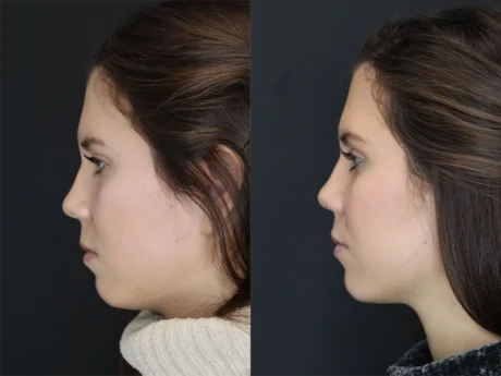 Facial Filler case #3638