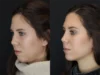 Facial Filler case #3638 slider thumbnail