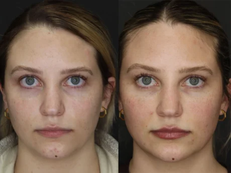 Facial Filler case #3645