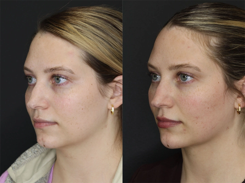 Facial Filler case #3645