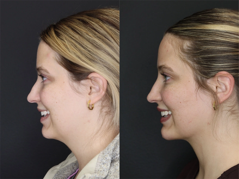 Facial Filler case #3645