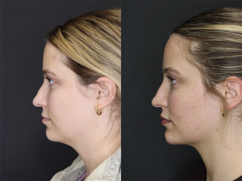Facial Filler case #3645