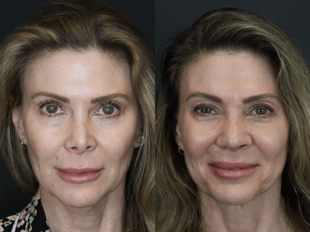 Revision Rhinoplasty case #3753