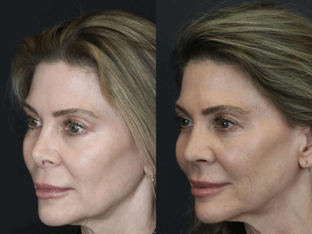 Revision Rhinoplasty case #3753