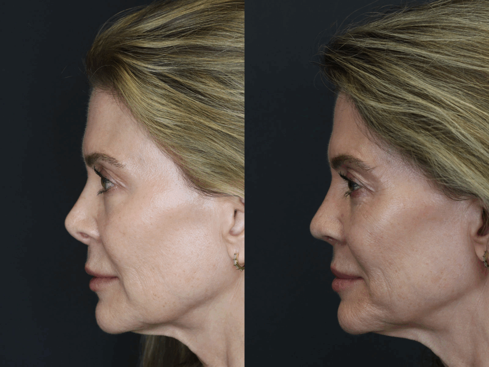 Revision Rhinoplasty case #3753