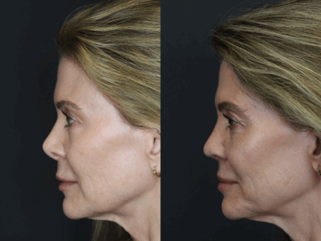 Revision Rhinoplasty case #3753
