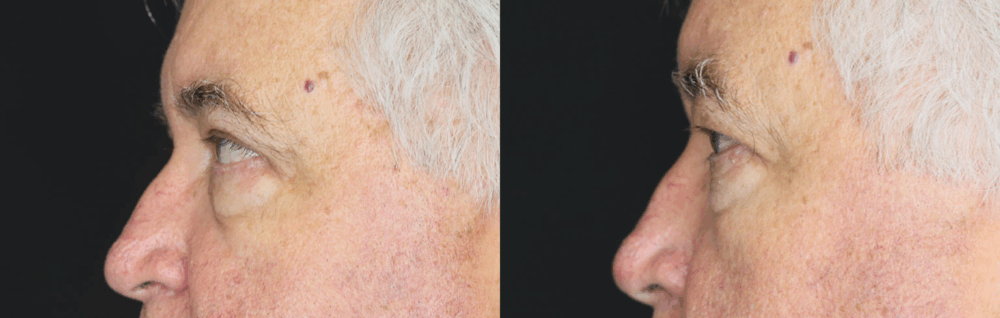 Blepharoplasty case #3315