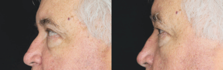 Blepharoplasty case #3315