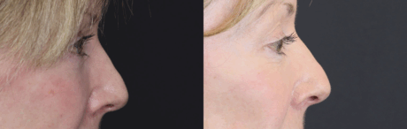 Blepharoplasty case #3800