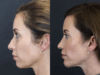 Facial Filler case #3760 slider thumbnail