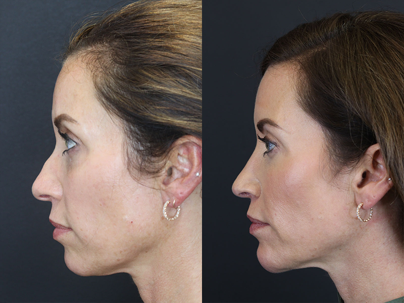 Facial Filler case #3760