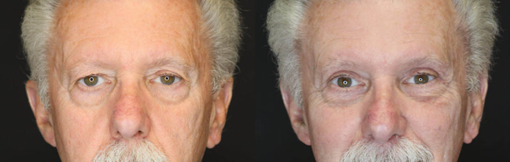 Blepharoplasty case #3370