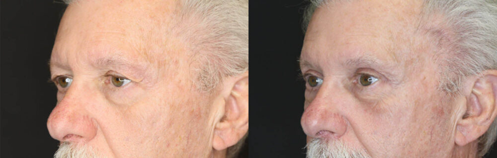 Blepharoplasty case #3370