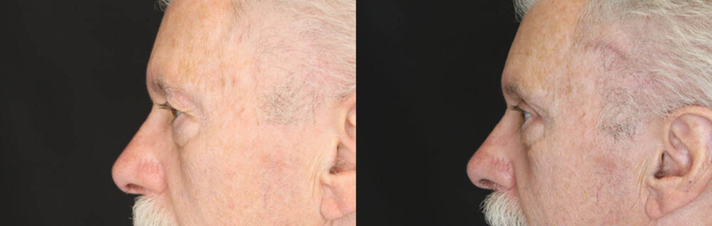 Blepharoplasty case #3370