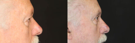 Blepharoplasty case #3370