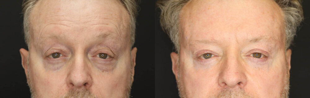 Blepharoplasty case #3397
