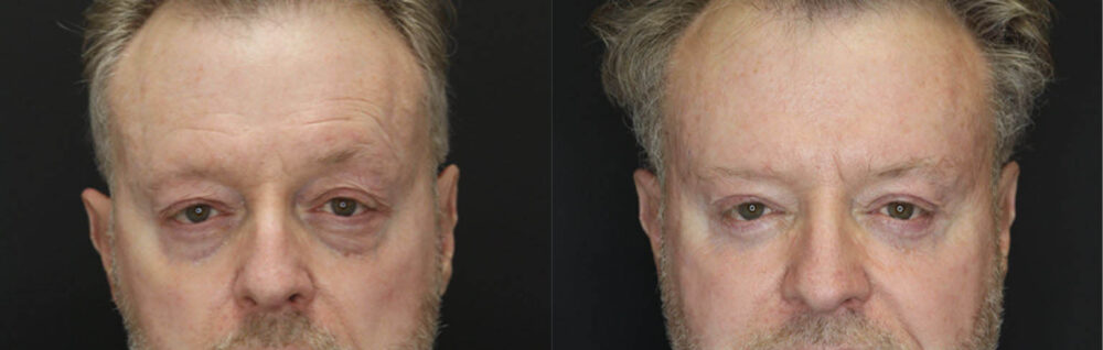 Blepharoplasty case #3397