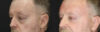 Blepharoplasty case #3397 slider thumbnail