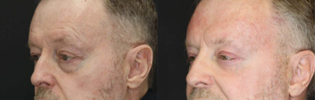 Blepharoplasty case #3397