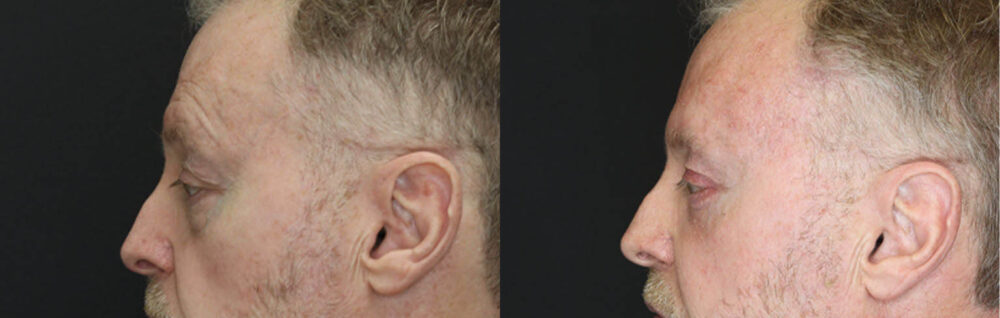 Blepharoplasty case #3397