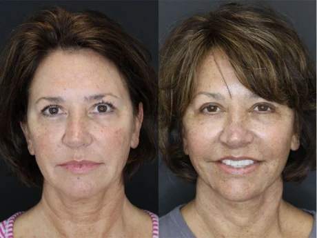 Facelift case #3515