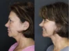Facelift case #3515 slider thumbnail