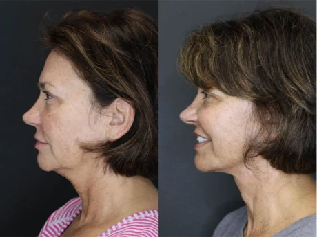 Facelift case #3515