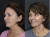 Facelift case #3515 slider thumbnail